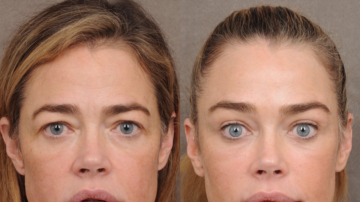 Denise Richards Discusses Her Facelift and Personal Challenges