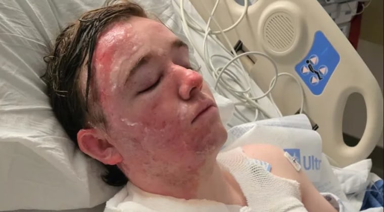 California McDonald’s Employee Sustains Severe Burns from Oil Attack