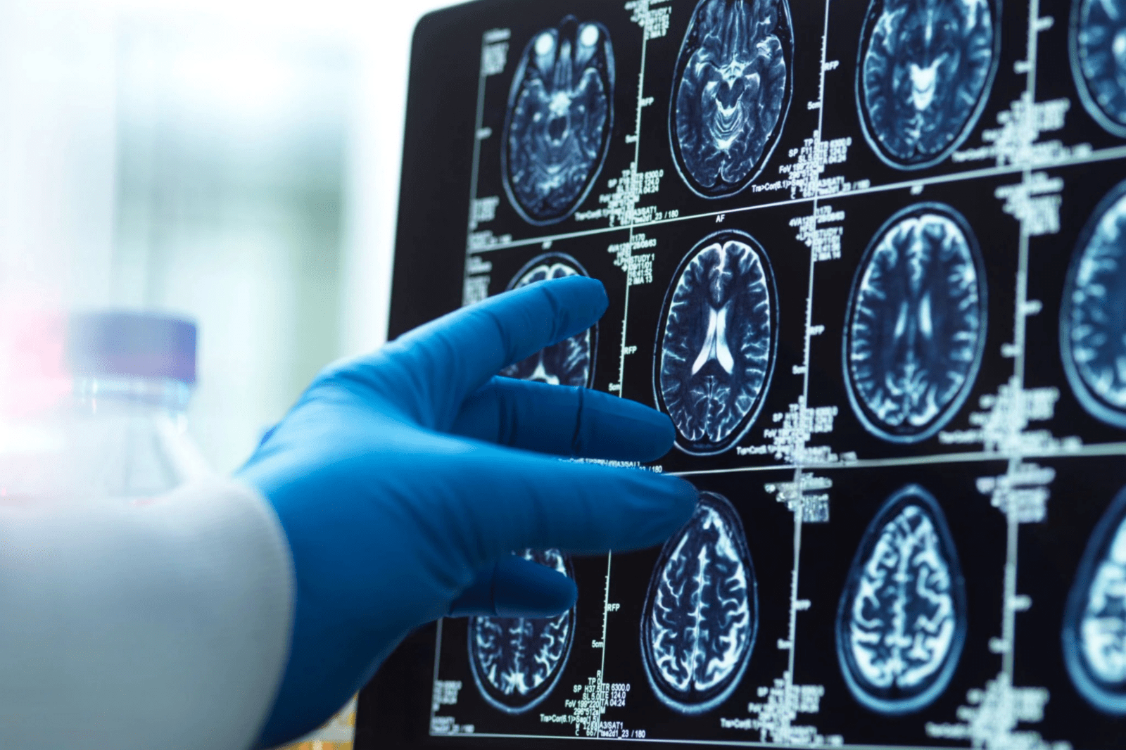 Potential Role of Tubulin in Neurodegenerative Disease Prevention