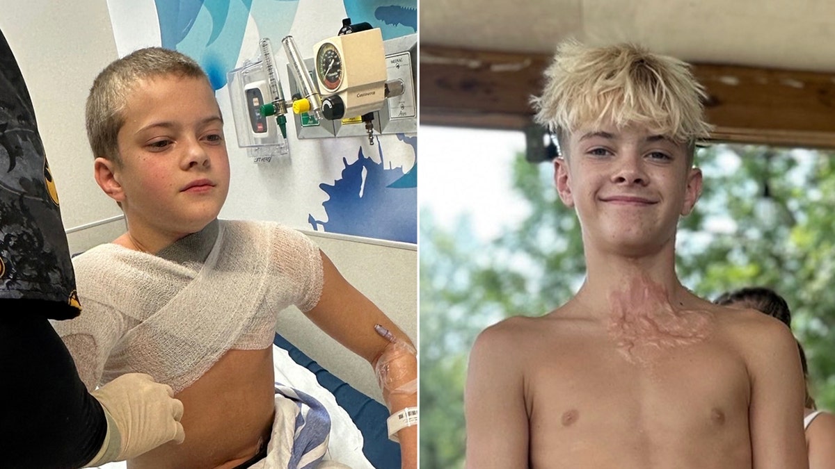 Teen Warns Against Viral Microwaving Trend After Severe Burns