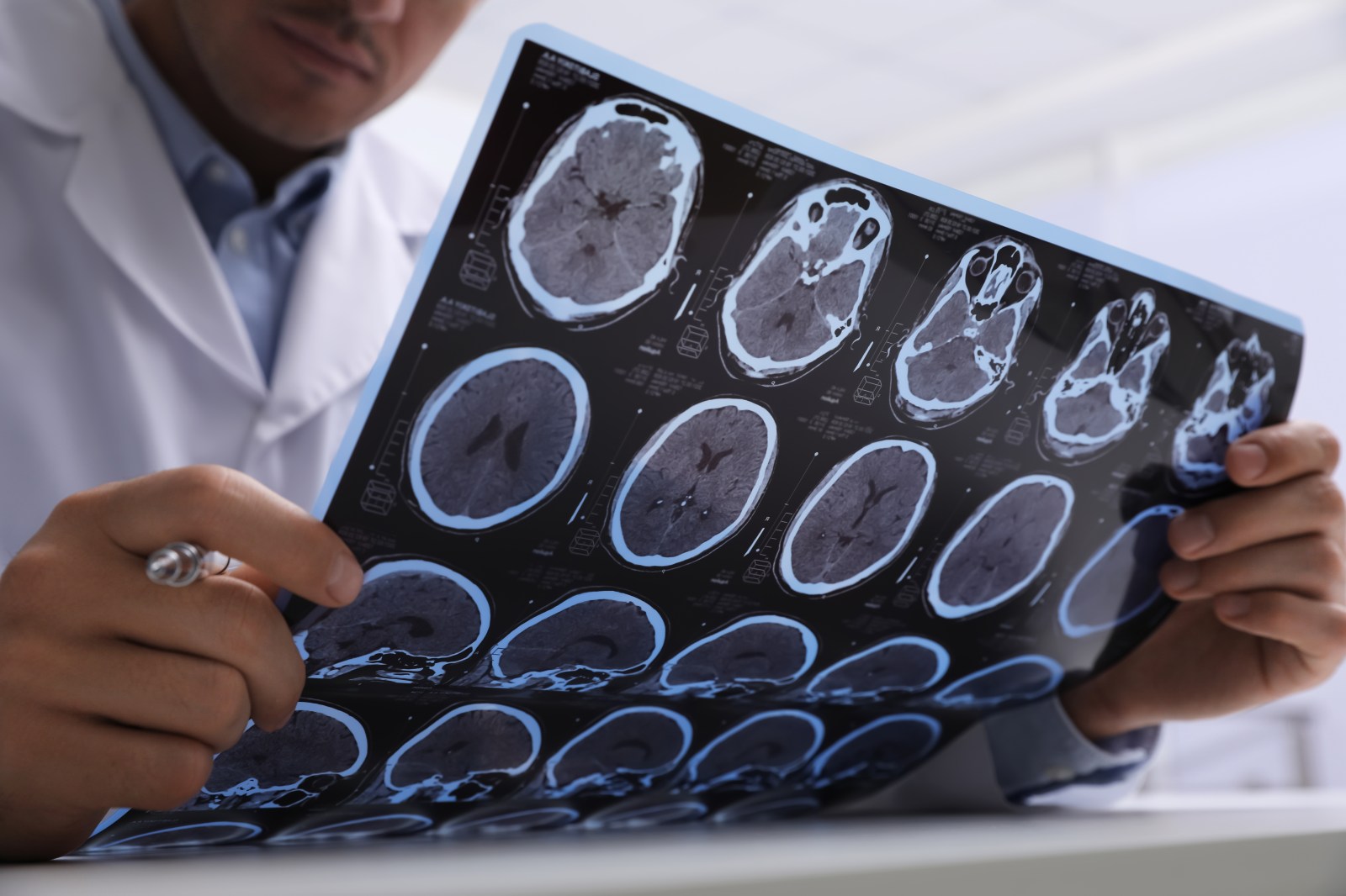 Impact of Early-Life Sugar Restriction on Alzheimer’s Risk