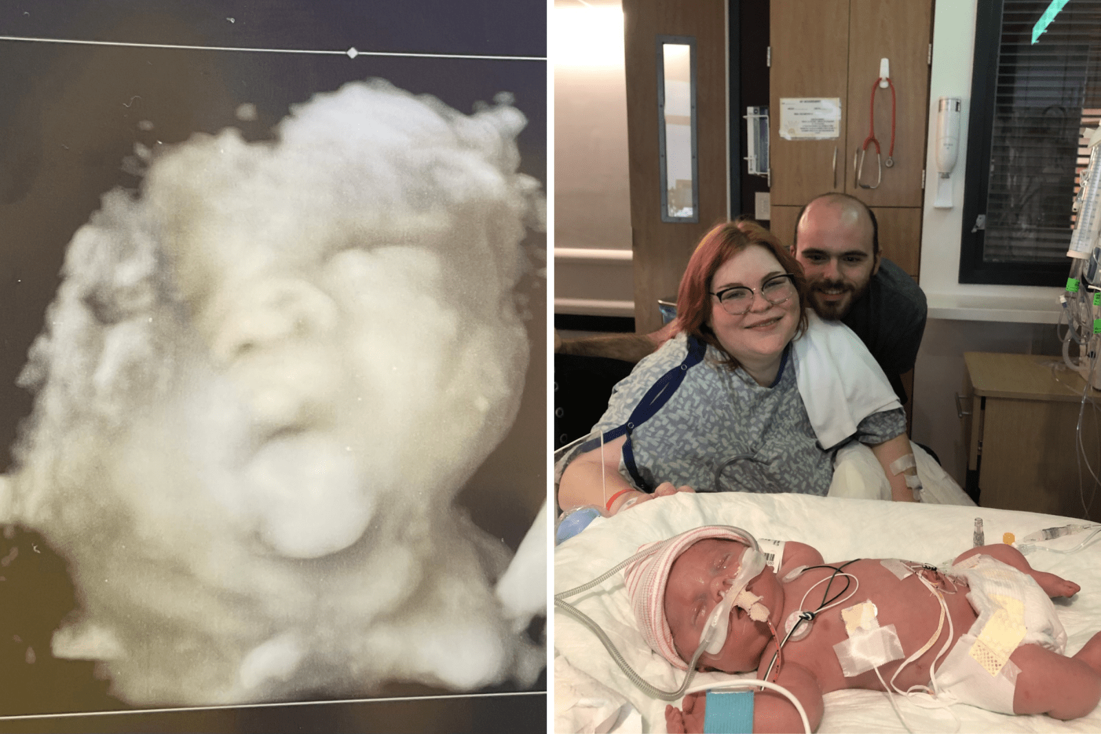 A Mother’s Journey Through Osteogenesis Imperfecta