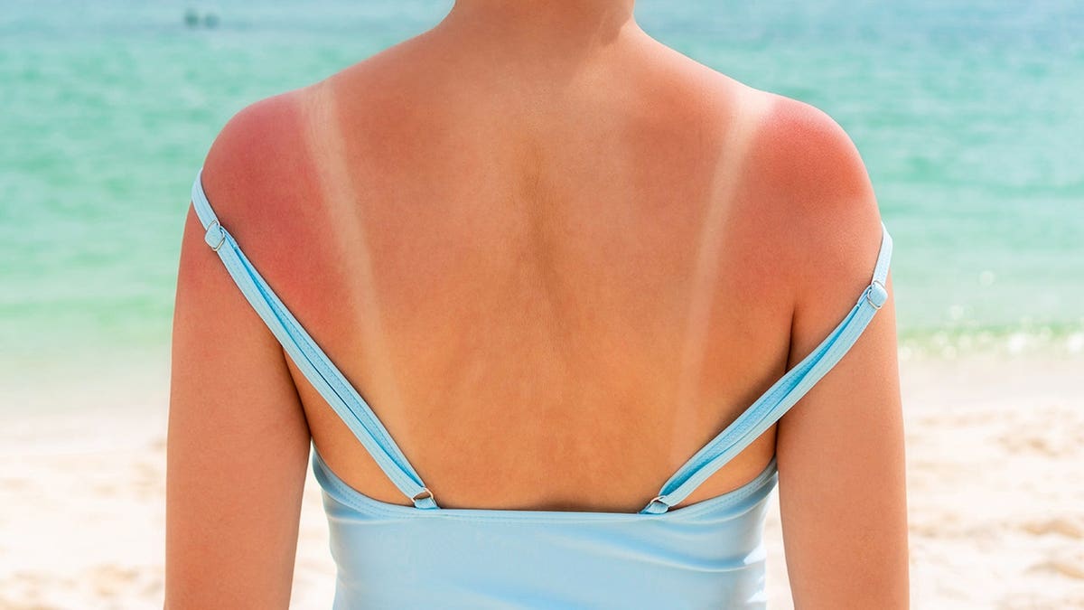 The Risky ‘Tanmaxxing’ Trend and Sun Safety Insights