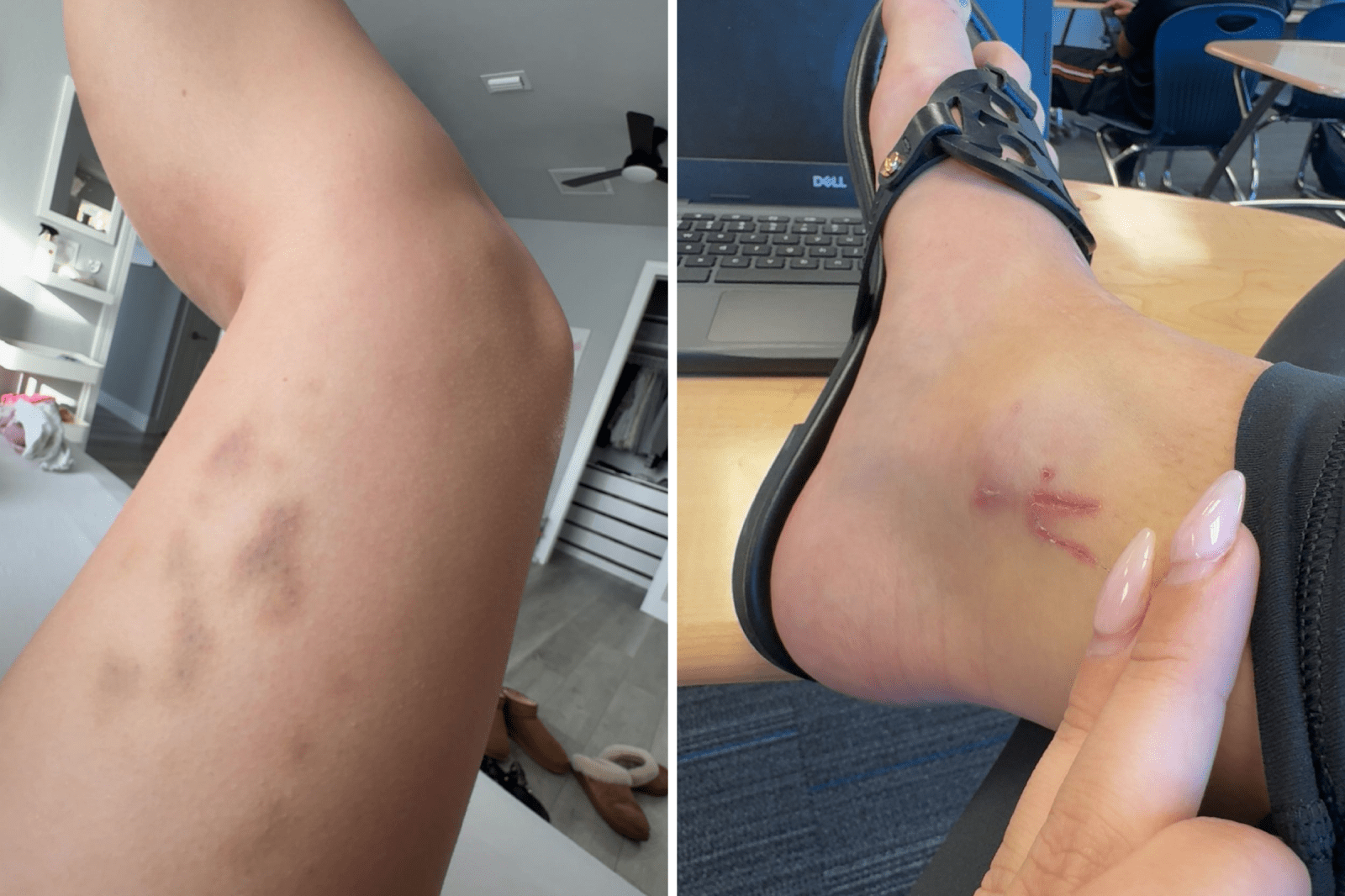 A Teen’s Unexpected Journey with Hodgkin’s Lymphoma