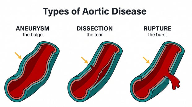 Understanding Aortic Disease: A Silent Threat