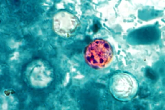 Cyclospora Illness Appears in 31 States, Hospitalizing 86