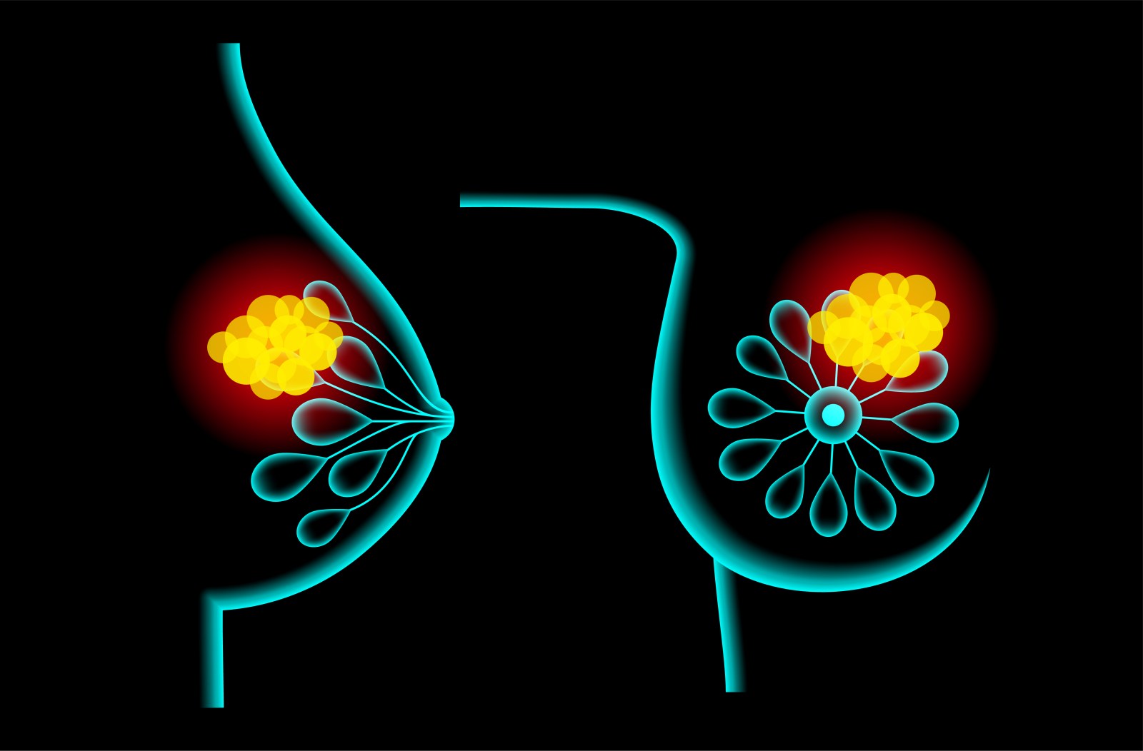 Study Reveals Breast Cancer Risk in Women with Family History Despite Negative BRCA Tests