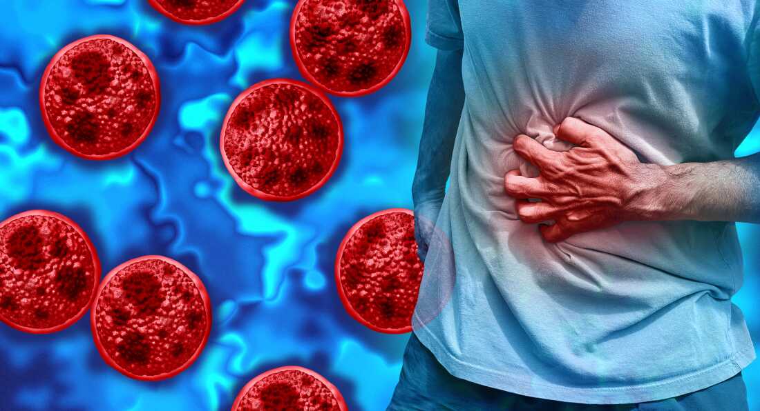 Cyclospora Outbreak Impacts Thousands in the U.S.