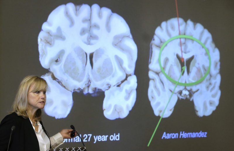 Study Reveals High Incidence of CTE Among NFL Players