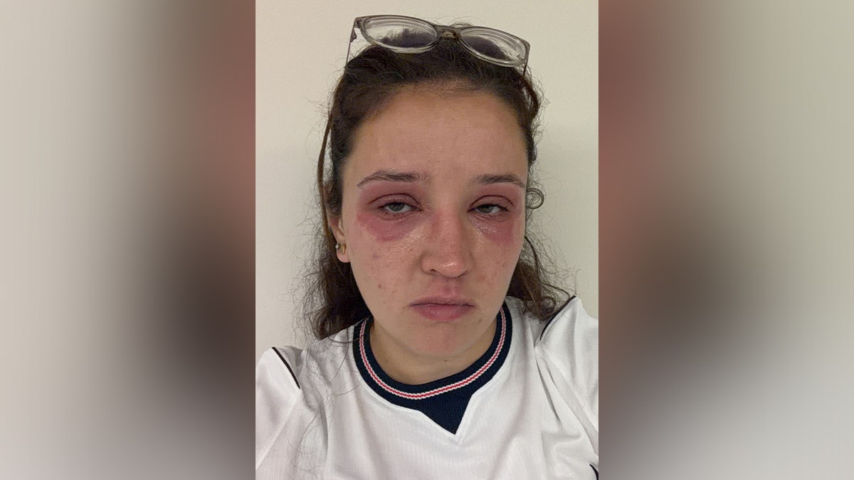 Bride-to-Be Faces Severe Reaction to Eyelash Extensions