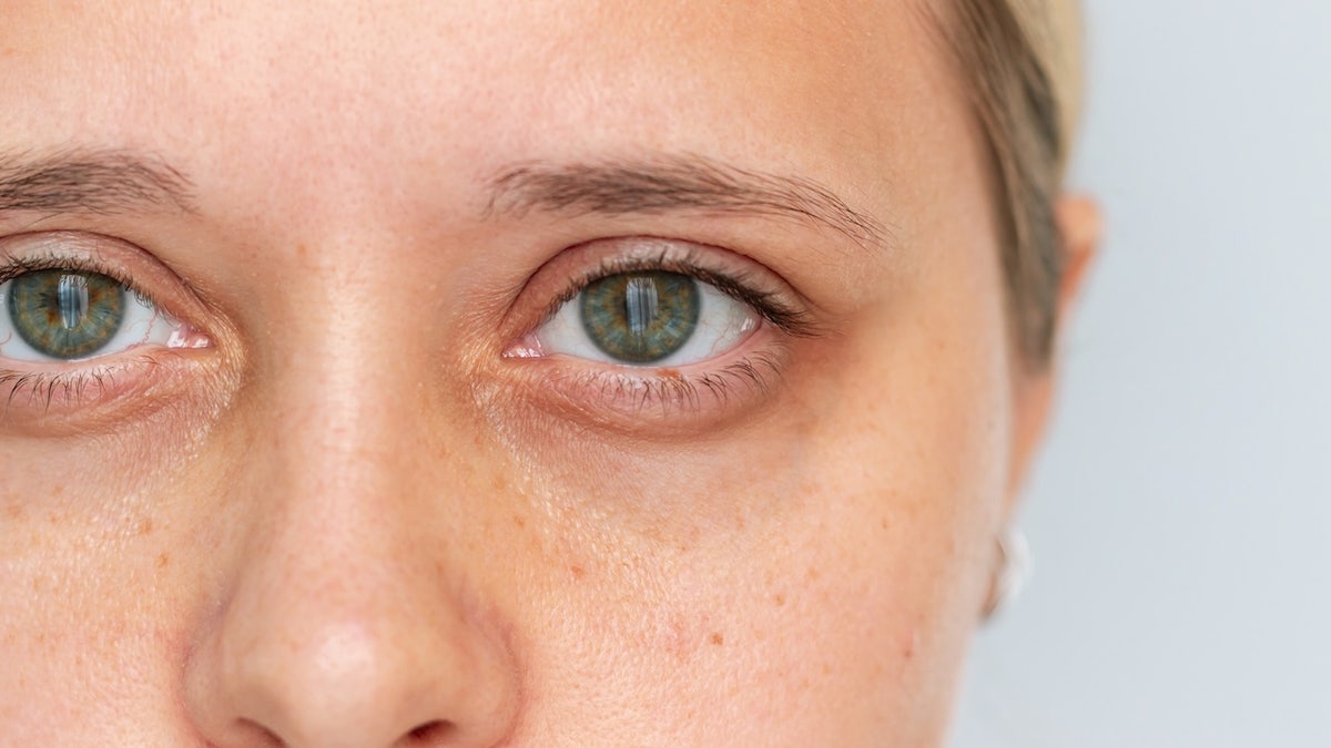 Understanding the Health Implications of Dark Under-Eye Circles