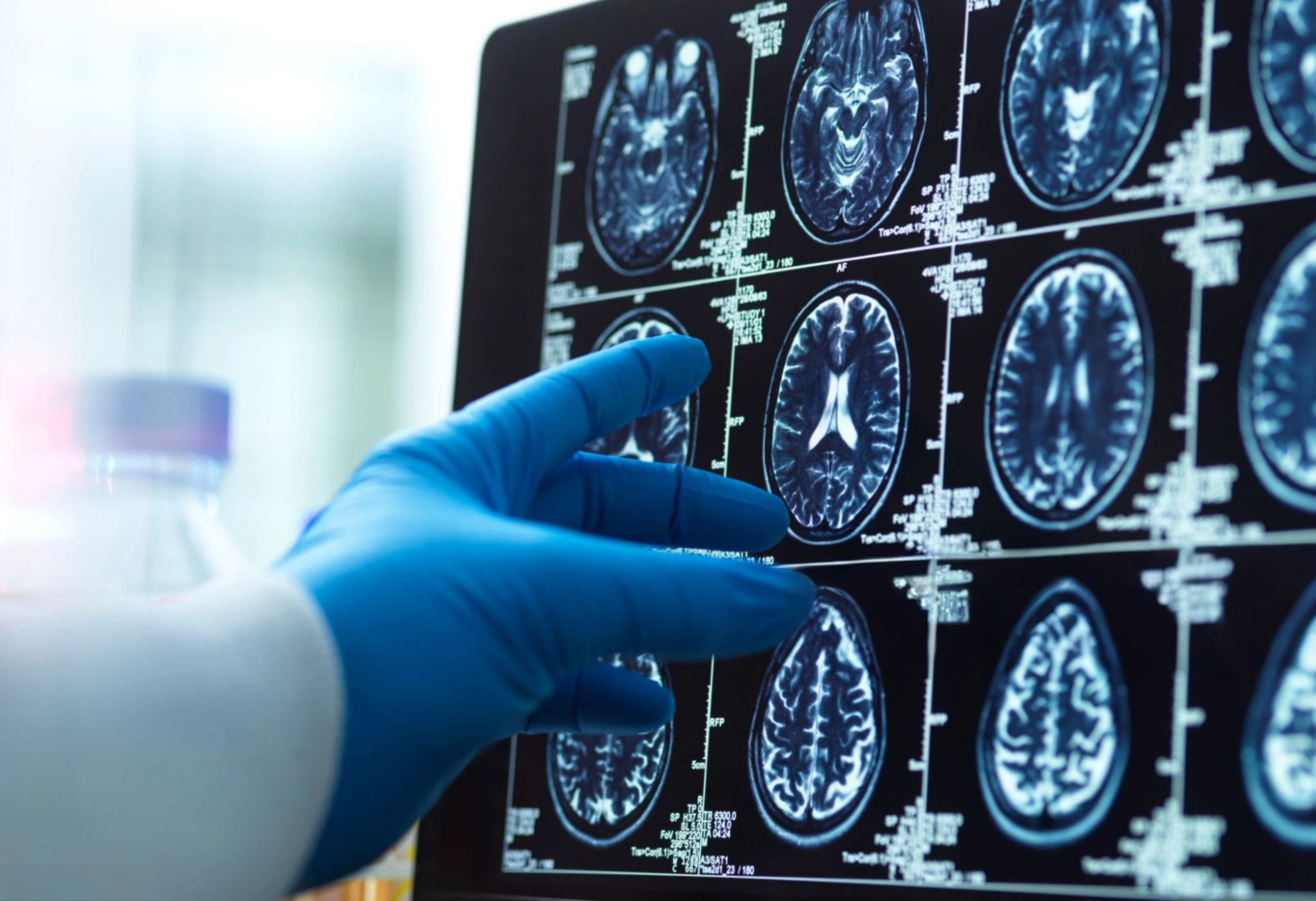 Newly Discovered Mitochondrial Plaques Could Transform Alzheimer’s Understanding