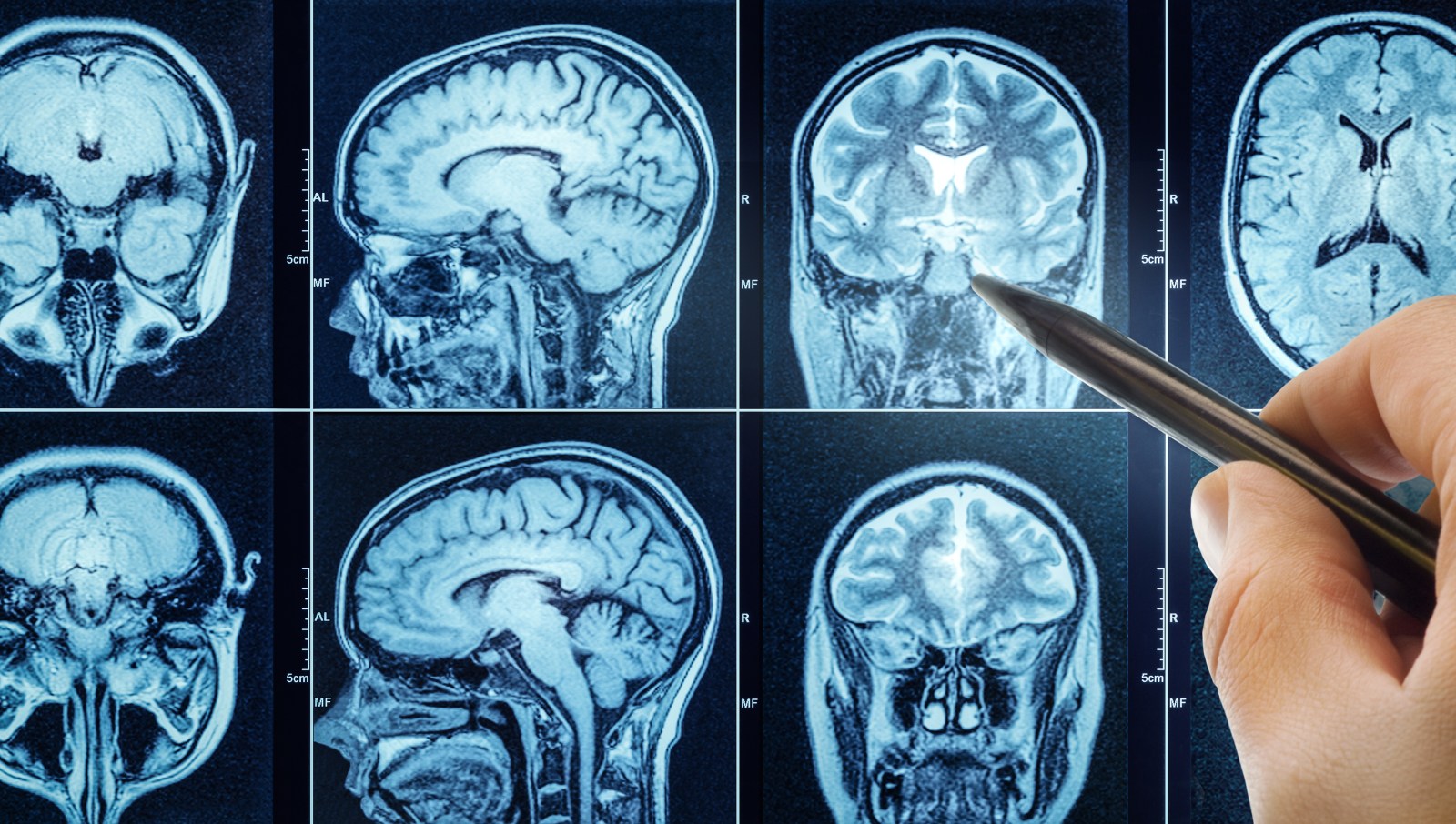 Modifiable Lifestyle Habits Linked to Dementia Risk