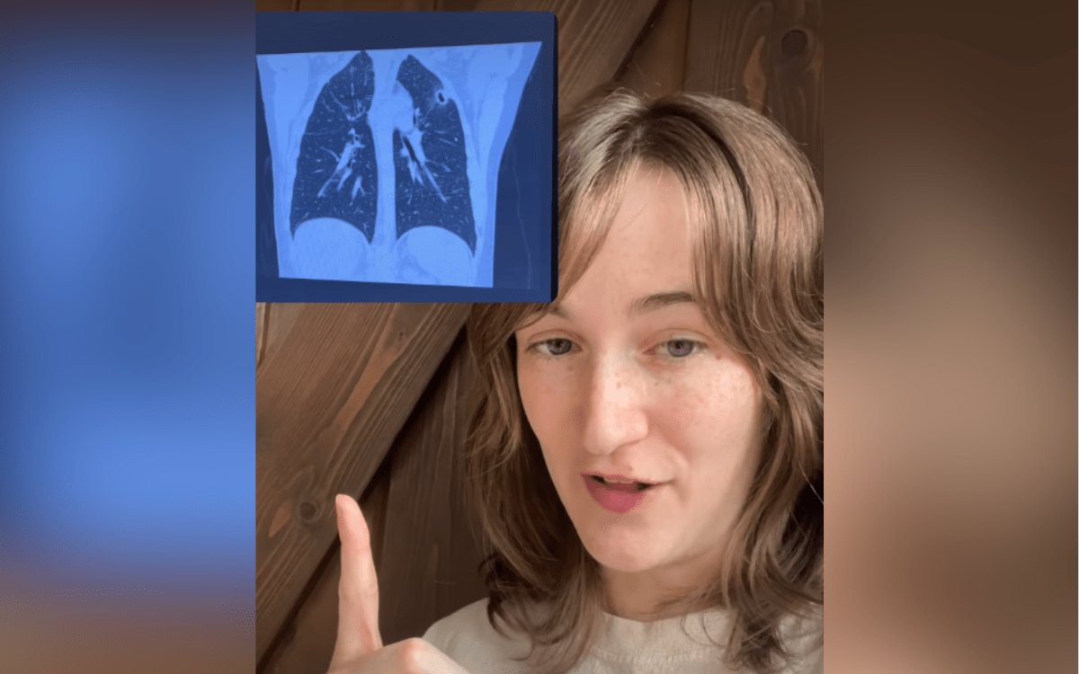 Woman’s Cough Misdiagnosed for Years Until X-Ray Revealed Valley Fever