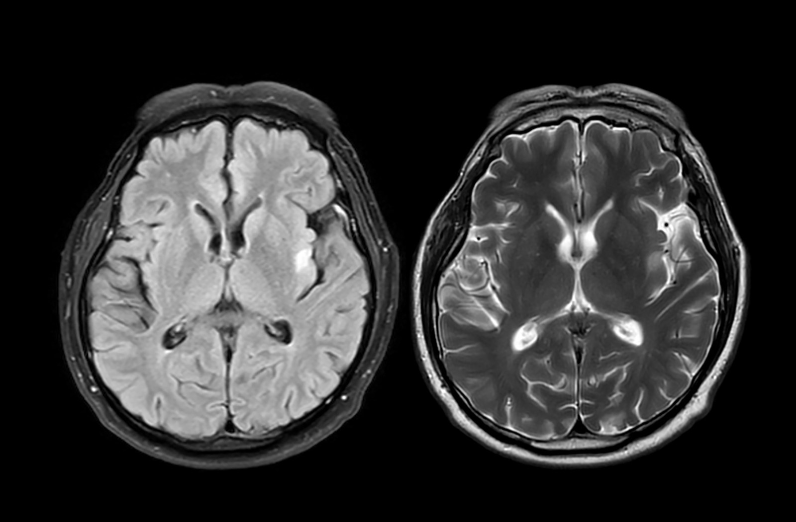 Brain Scan Tool Predicts Alzheimer’s Progression