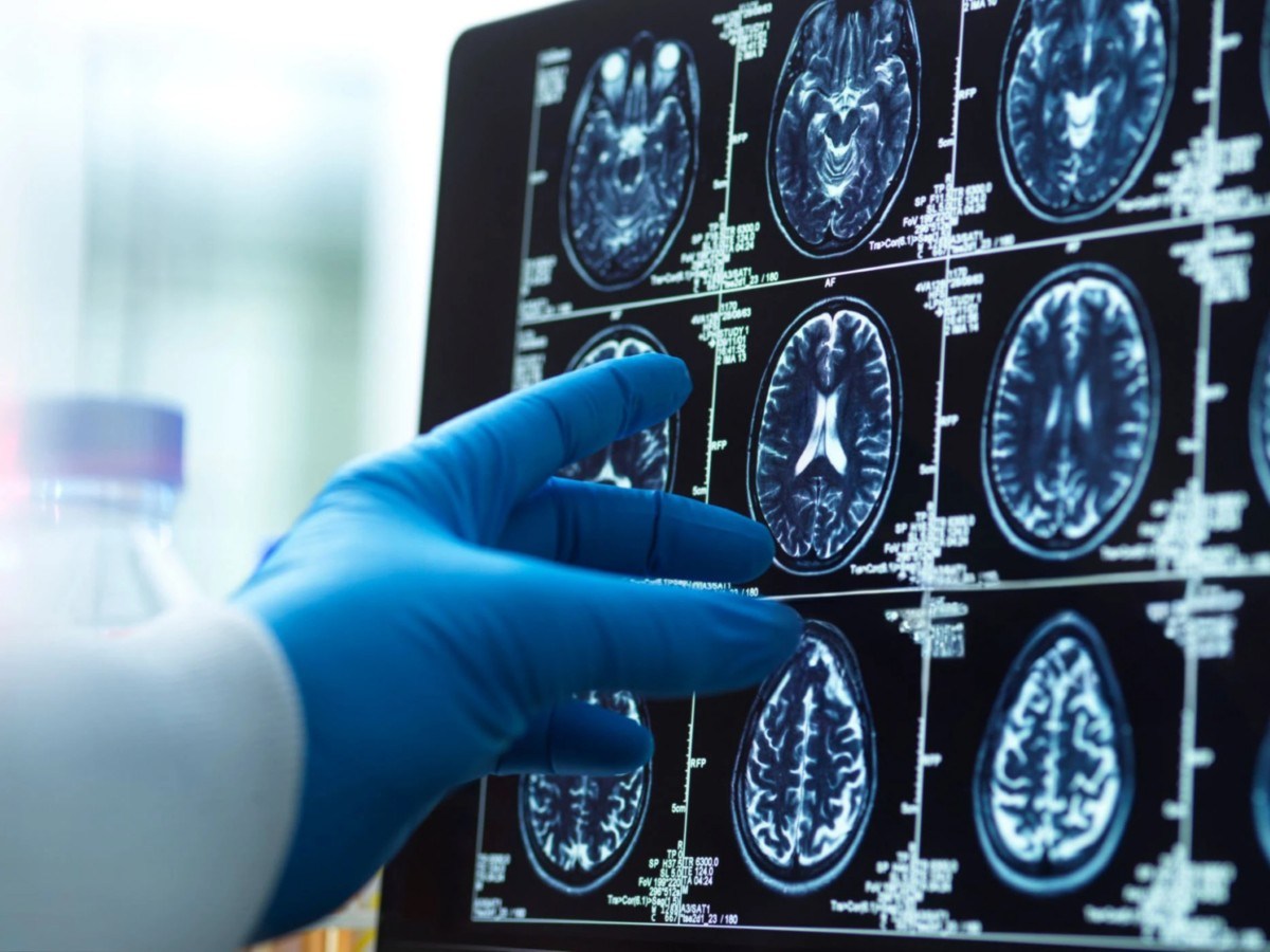 FDA Clears New Blood Test for Alzheimer’s Diagnosis: A Step Forward