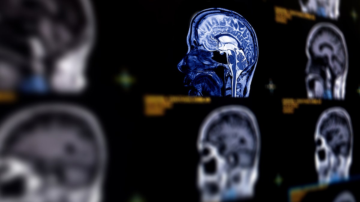 Understanding Memory Lapses in Midlife Women