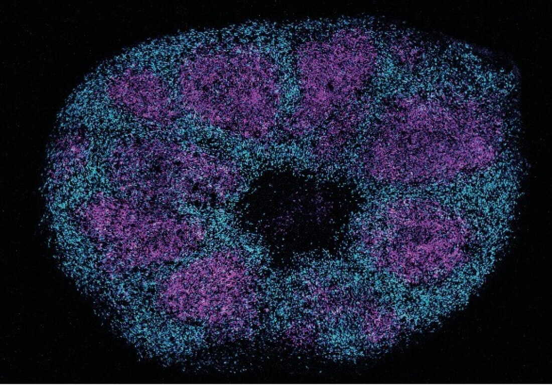 Scientific Advances in Understanding Profound Autism Through Protein Mapping