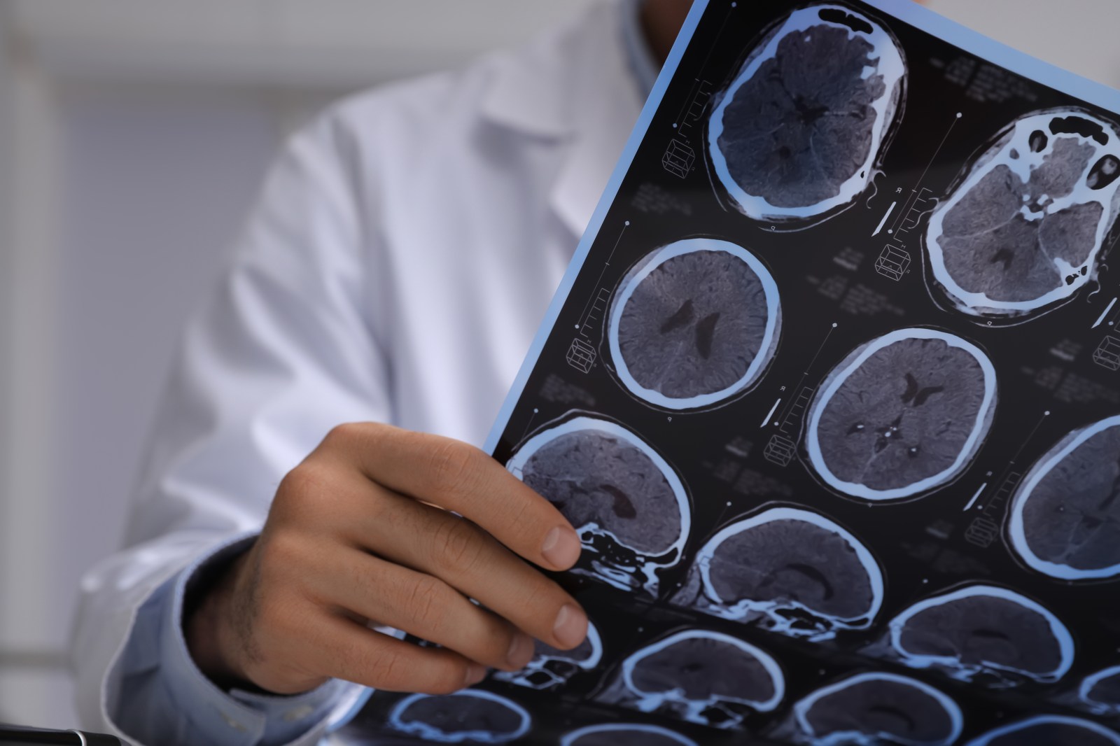 Early Brain Changes Linked to Alzheimer’s Detected Long Before Plaques