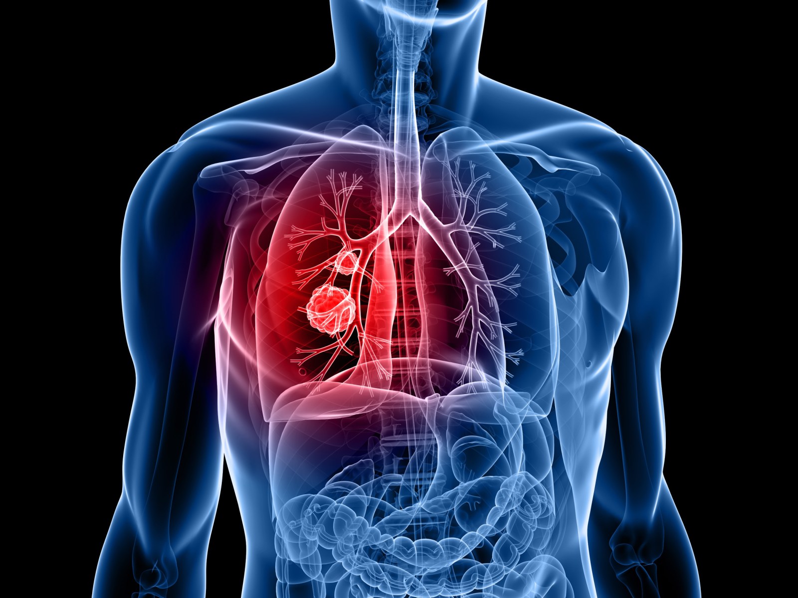Rare Genetic Mutation Links to Higher Lung Cancer Risk
