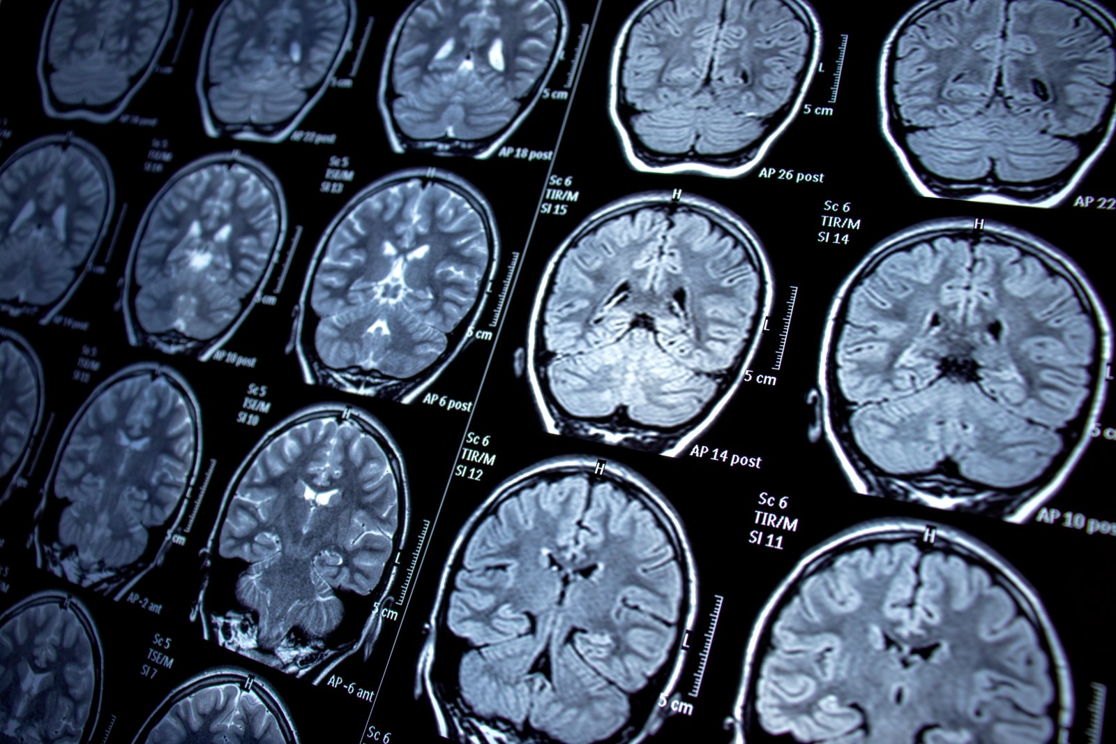 Scientific Breakthrough in Alzheimer’s Research: Immune Response Restoration