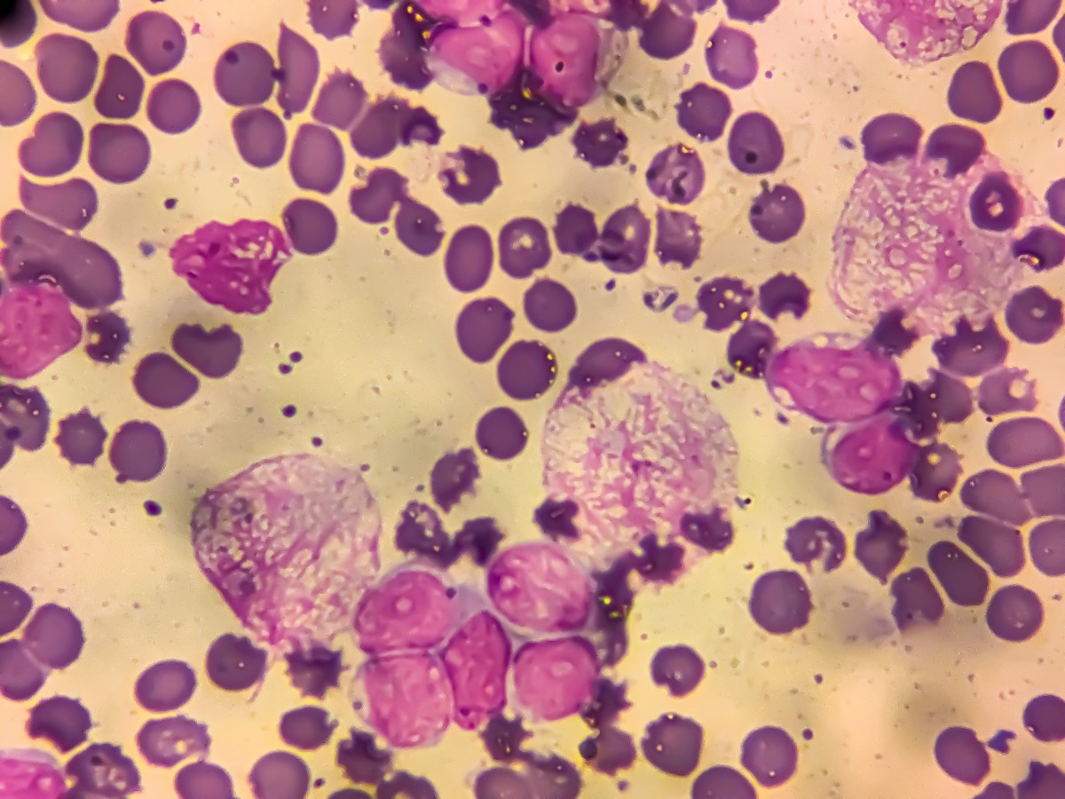 Study Highlights Infection’s Role in Global Cancer Cases