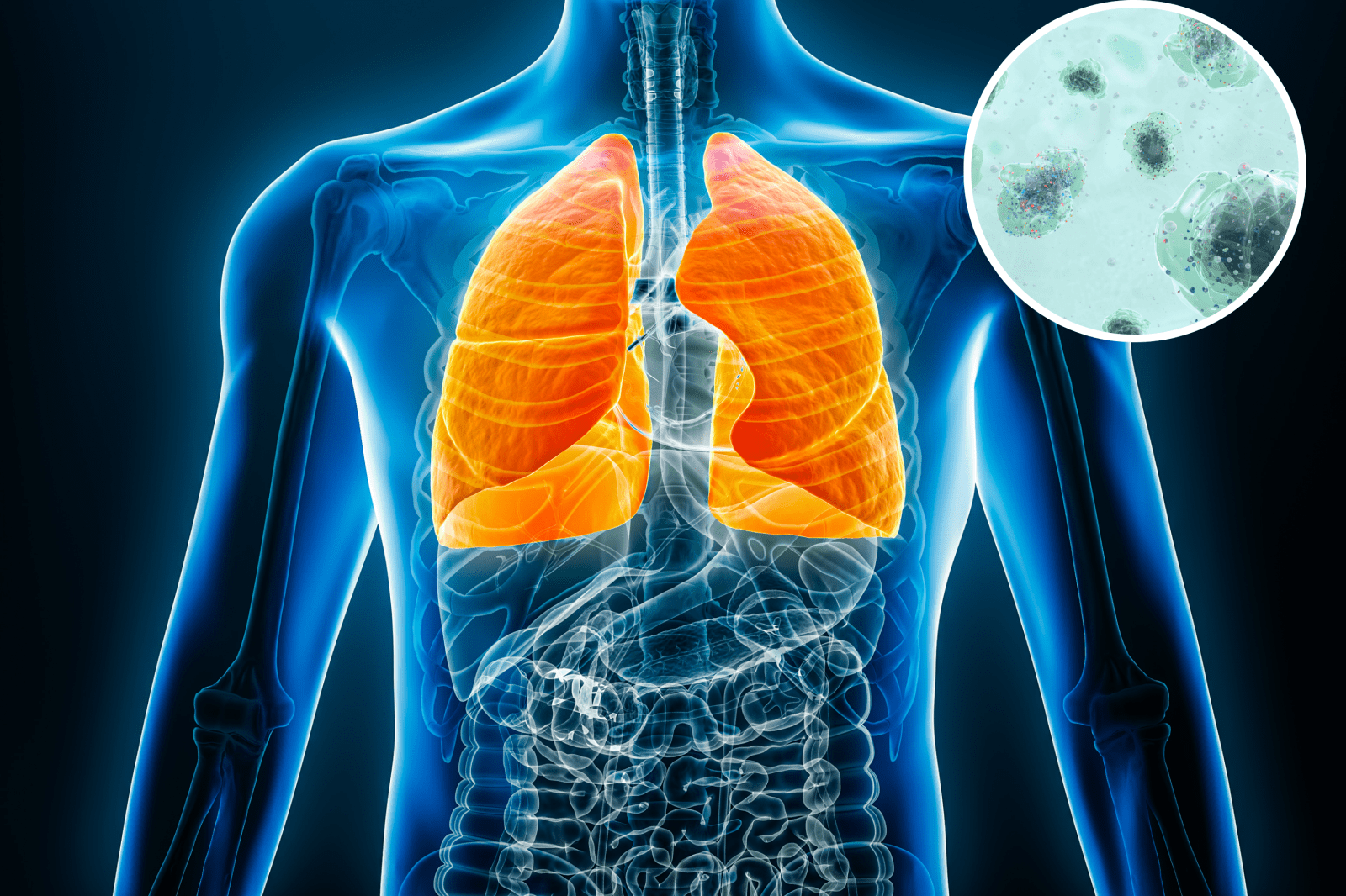 Microplastics in Lungs: A Look into Their Possible Link to Lung Cancer