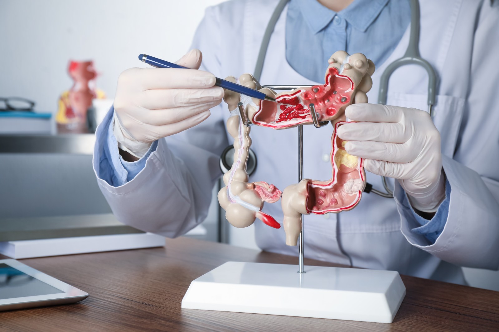 Early-Onset Bowel Cancer: Distinct Characteristics and Treatment Approaches