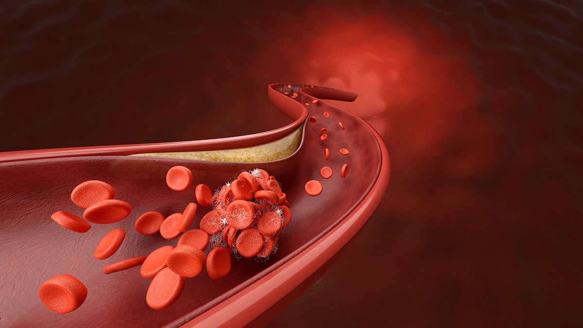 Statin Therapy After Type 2 Diabetes Diagnosis: Heart and Dementia Benefits