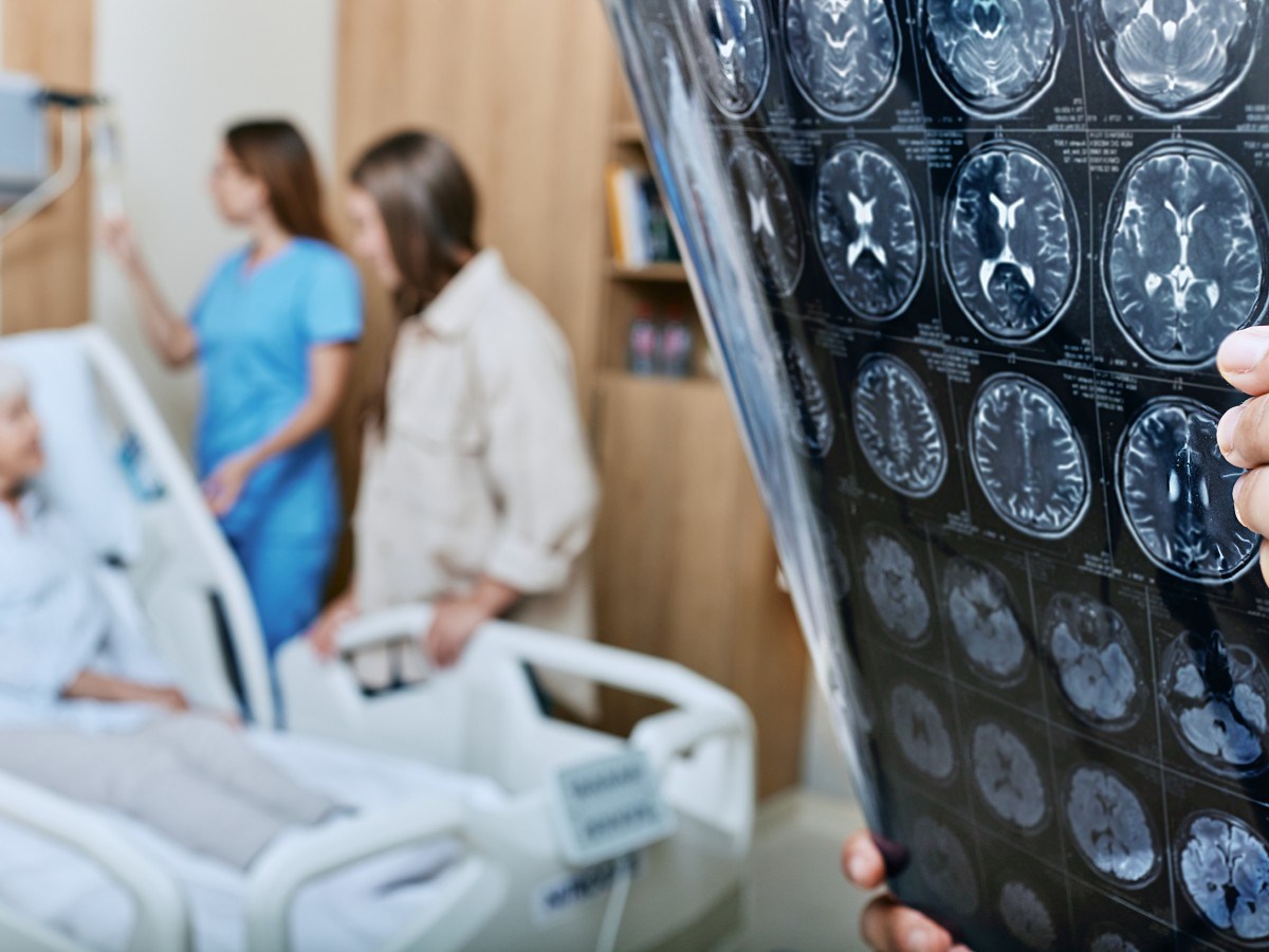 Rising Stroke Risk Among Younger Adults: Causes and Prevention